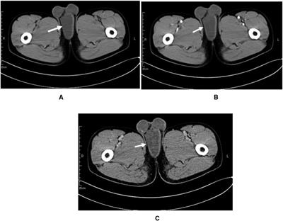 Giant superficial angiomyxoma of the male perineum: A case report